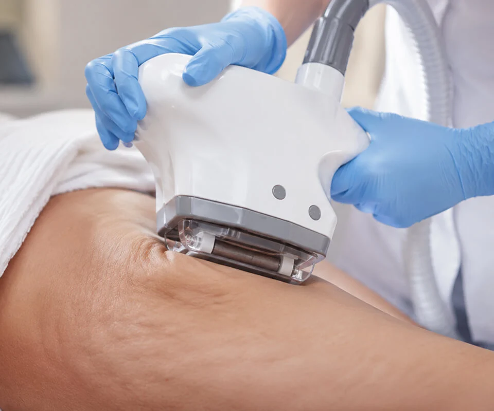 VelaShape от целлюлита: помогает ли процедура и на каких стадиях ждать эффект